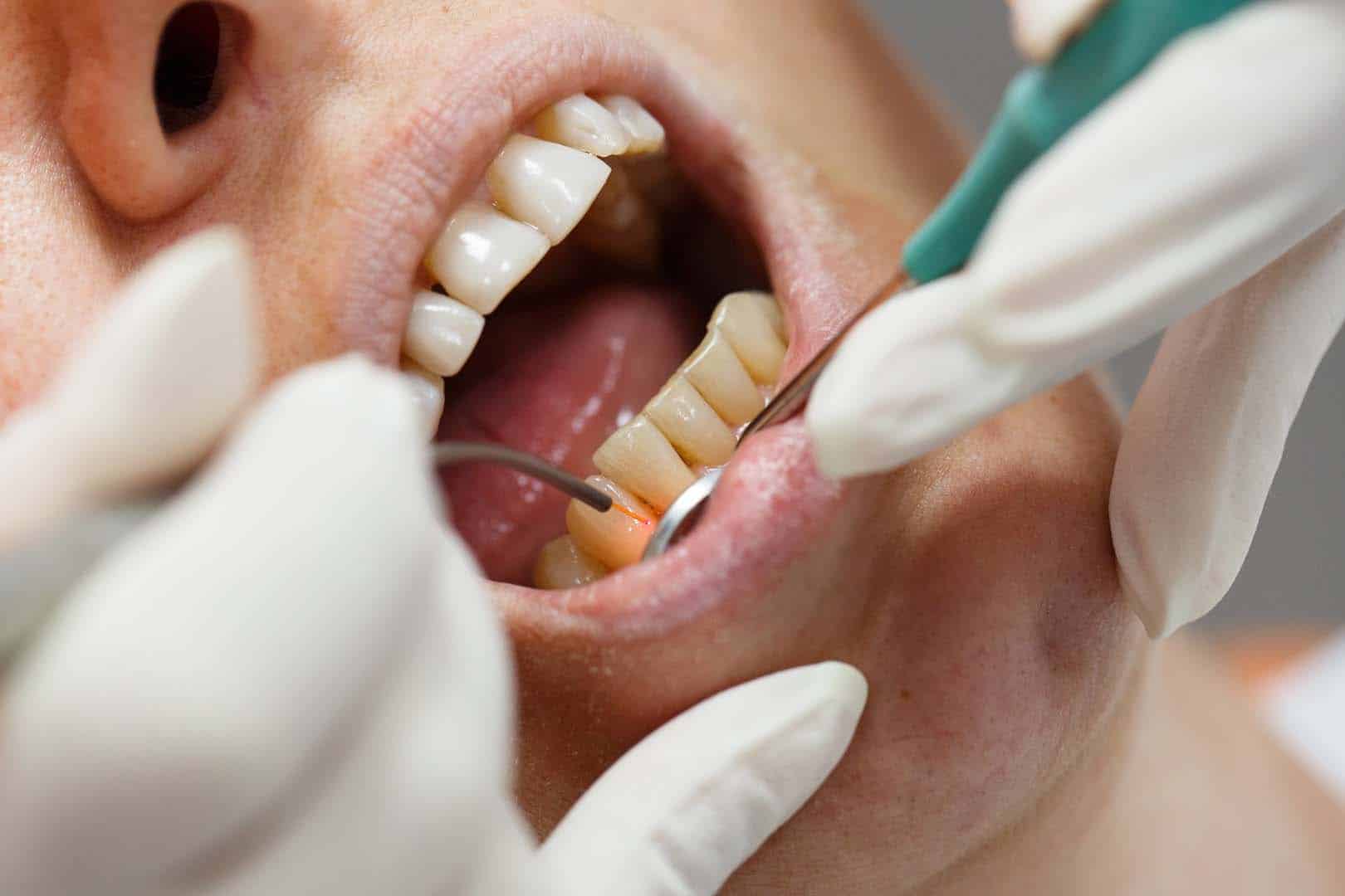 Dental Implants Atlanta GA